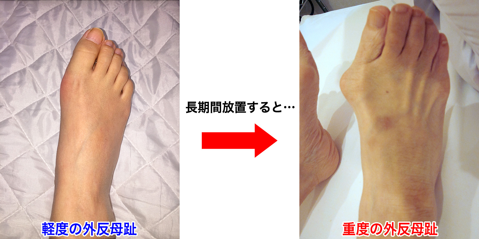 外反母趾とは