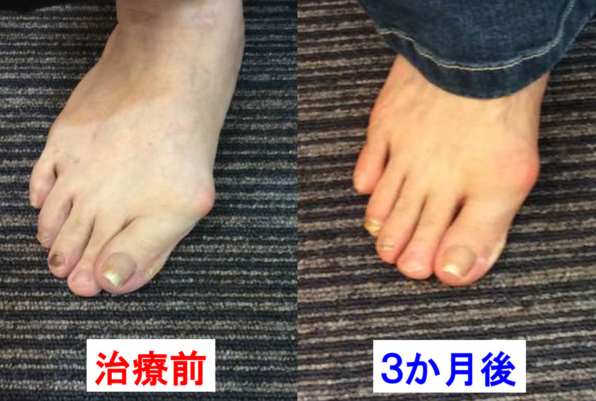 外反母趾の改善1