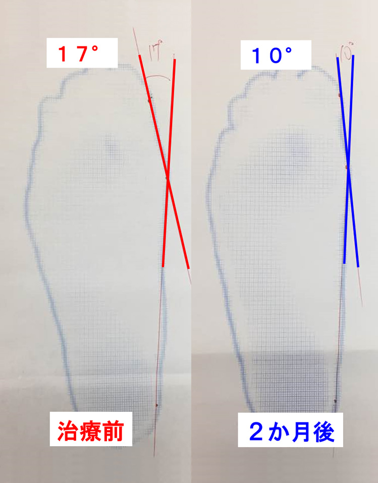 外反母趾の改善3