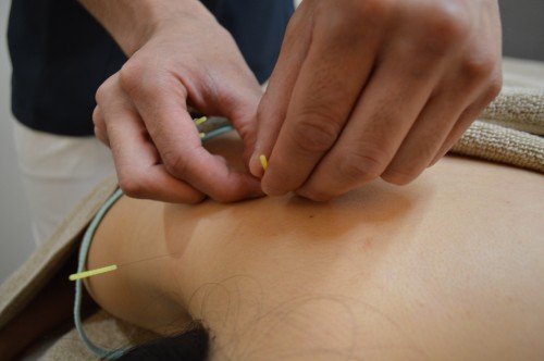 腰痛に鍼灸治療って効果あるの？もっと効果的な治療はあるの？