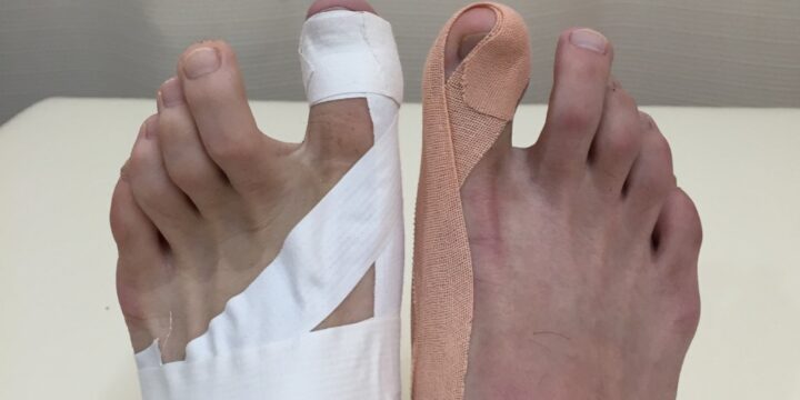 「間違ったテーピングは外反母趾を悪化させる」正しいテーピングの方法をご紹介。