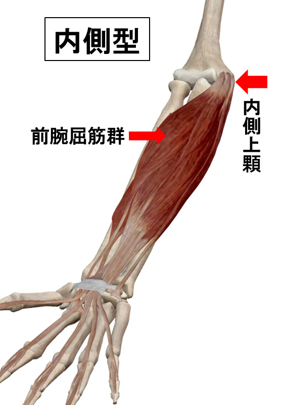 内側型