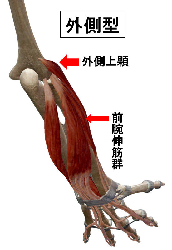 外側型