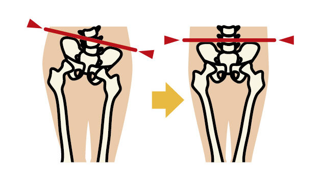 「骨盤がゆがむと腰痛になる？」治療家が教えたくない腰痛のヒミツ