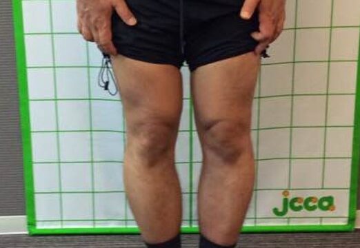 「O脚専門院」なのになぜ男性は治療を断られるのか？