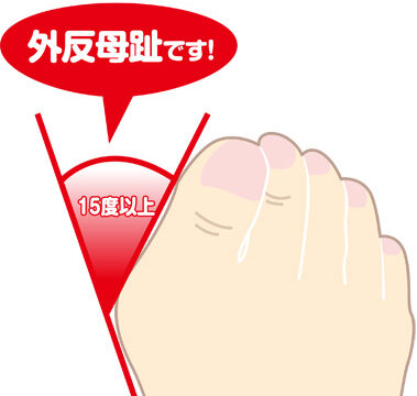 外反母趾ならこれだけはやってほしい！この筋肉を緩めると予防改善ができます。