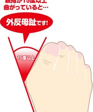 外反母趾を改善するポイントは「指を使えるようにすること」
