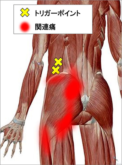 関連痛