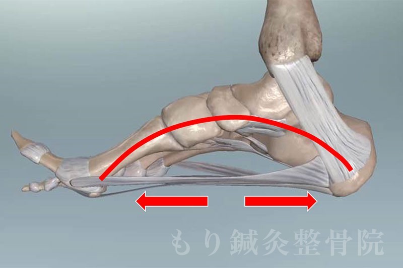 足底筋膜炎とは
