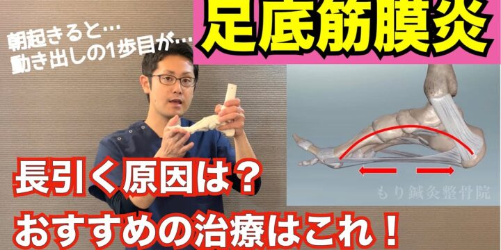 足底筋膜炎が治りにくい理由と効果的な治療法