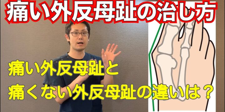 痛い外反母趾の原因とおすすめの治療