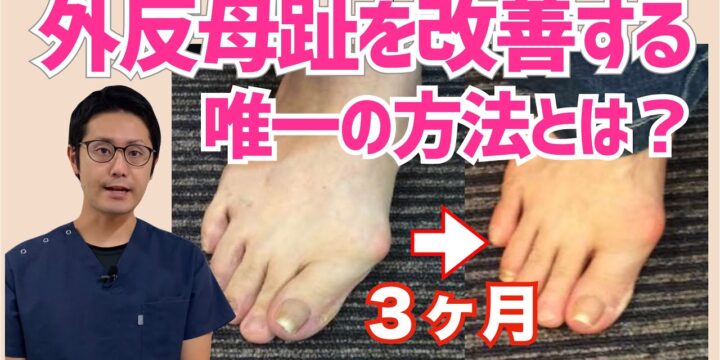 手術をせずに外反母趾を改善する方法