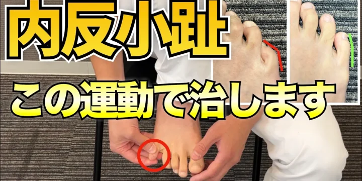 内反小趾の原因と自分で改善するためのセルフケア