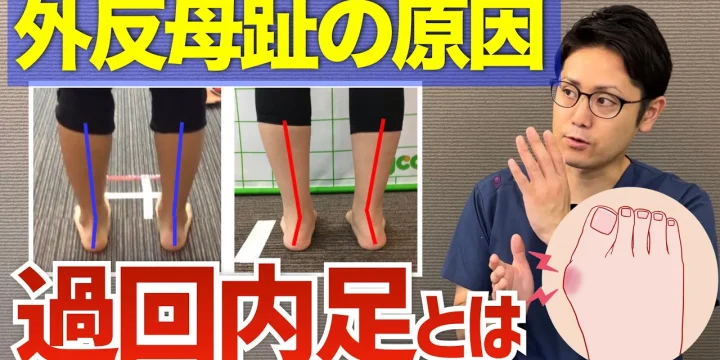 【外反母趾の原因は足首にあった】過回内足の治し方について　