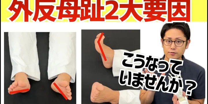 あなたは大丈夫？外反母趾が悪化しやすい2つの要素とは